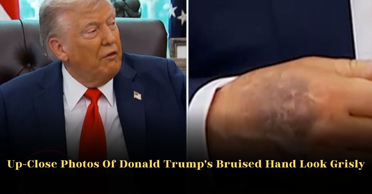Up-Close Photos Of Donald Trump’s Bruised Hand Look Grisly